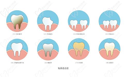 仿生復(fù)合瓷牙貼面適應(yīng)人群