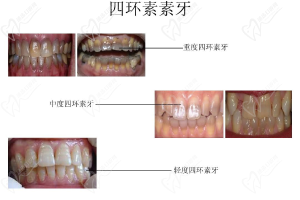 四環(huán)素牙美白價(jià)格