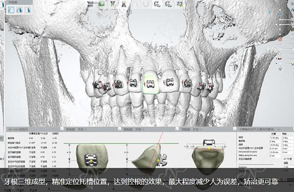 德倫口腔矯正牙齒怎么樣正畸模擬設計