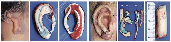八大處耳再造手術(shù)哪個醫(yī)生好
