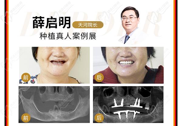 廣州柏德口腔醫(yī)院種植牙院長[薛啟明]