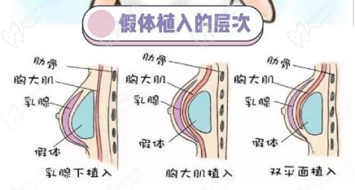 謝衛(wèi)國隆胸技術怎么樣