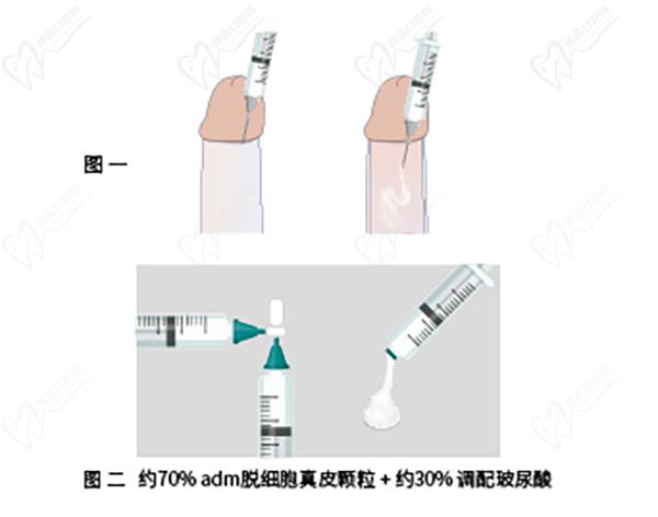 男科增粗生物補(bǔ)片