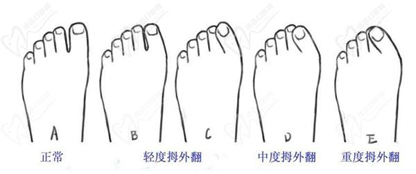 大腳骨手術的費用大概是多少錢啊