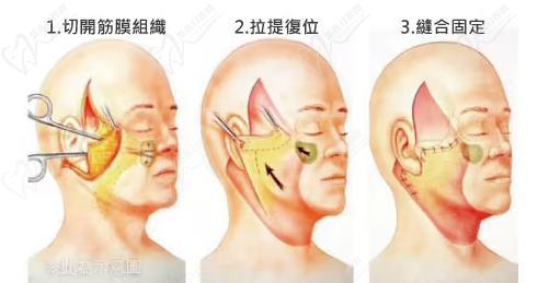 廣州黃廣香擅長(zhǎng)什么手術(shù)